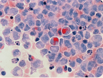 Cáncer
